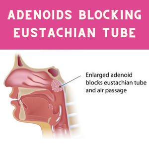 adenoids block Eustachian tube
